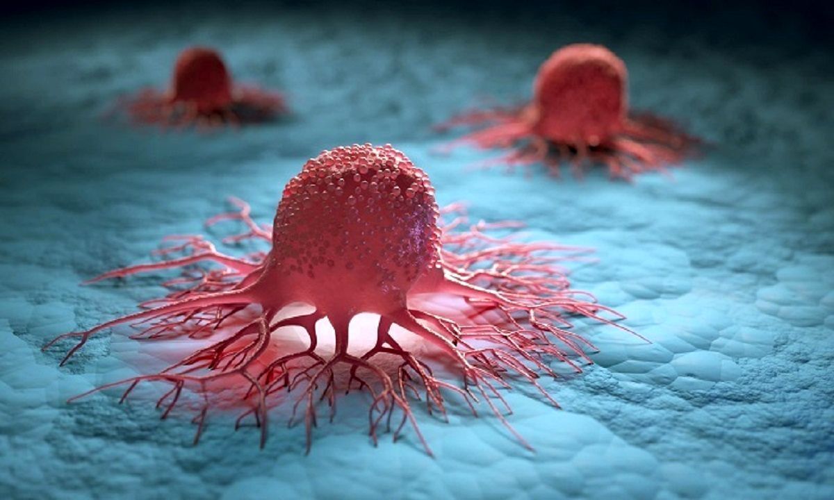 چهار علامت ابتلا به سرطان سینه در مردان