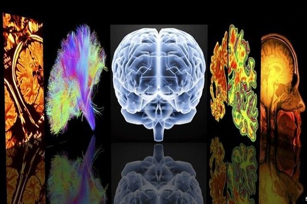 اسکیزوفرنی با خطر ابتلا به زوال عقل ارتباط دارد؟
