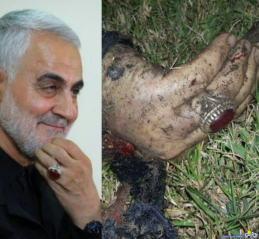 دست و انگشتر شهید سلیمانی پس از جنایت آمریکا/عکس