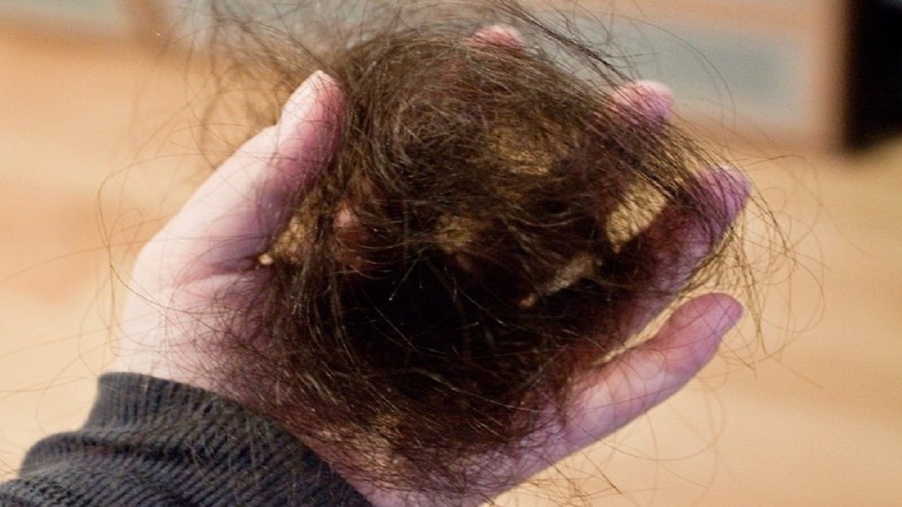 ریزش مو یکی از عوارض کروناست