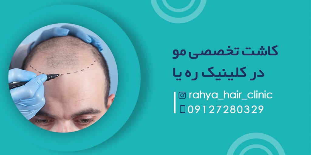 روش های مختلف کاشت مو چگونه است؟ روش های مختلف کاشت مو چگونه است؟