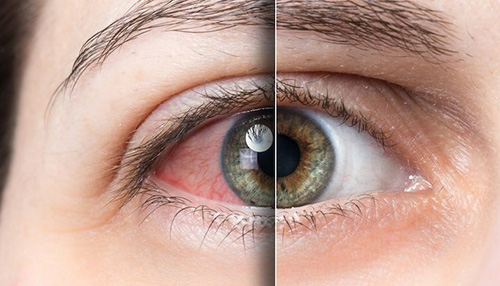 رفع خستگی چشم