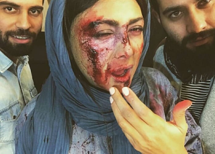 صورت زخمی خانم بازیگر؟! عکس