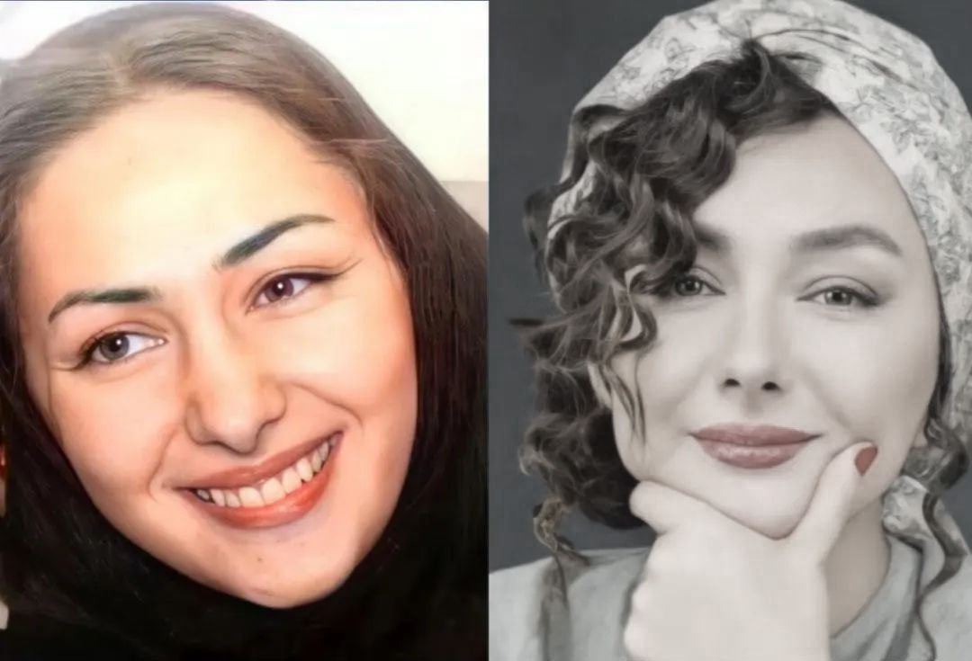 عکس قبل و بعد از عمل بینی هانیه توسلی
