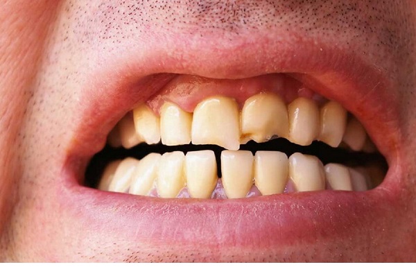 هفت عادت مضر برای سلامت دندان‌ها