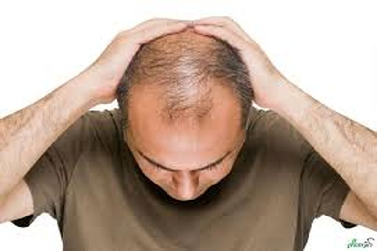 راهکارهای عملی برای درمان ریزش موی سر در مردان
