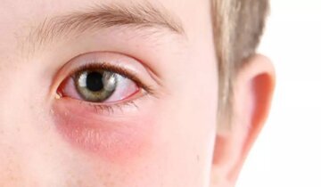 تعطیلی مدارس به دلیل شیوع عفونت چشم در همسایه شرقی ایران تعطیلی مدارس به دلیل شیوع عفونت چشم در همسایه شرقی ایران