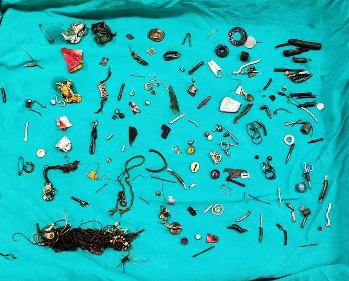 کشف ۱۵۰ شی از جمله دستبند و سمعک در شکم بیمار