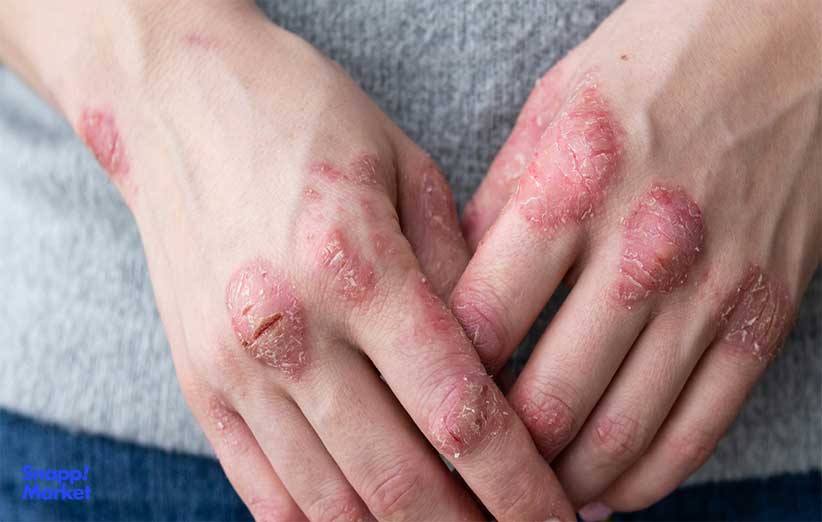 psoriasis-disease-meaning