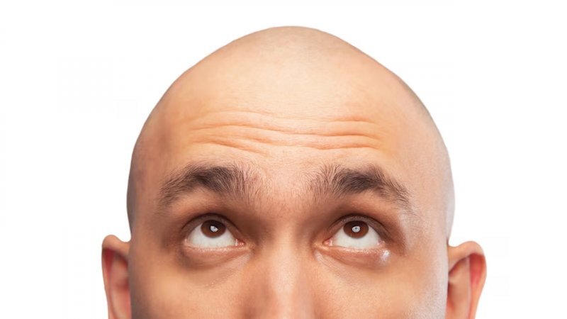 مردان کدام کشورها کچل ترند؟/ ایران در رتبه چندم است؟+ نمودار مردان کدام کشورها کچل ترند؟/ ایران در رتبه چندم است؟+ نمودار