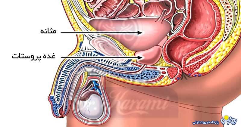 بیماری پروستات چیست و راه‌های درمان آن کدامند؟