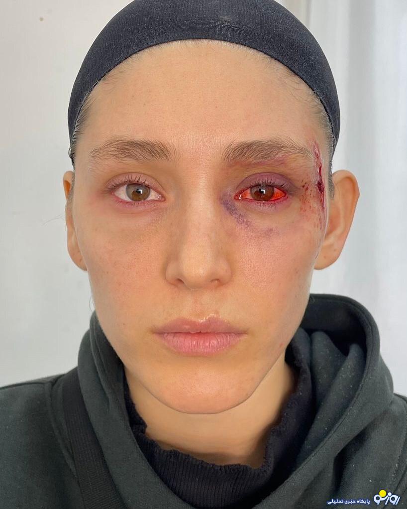 آثار ضرب و شتم روی صورت فرشته حسینی /تصاویر