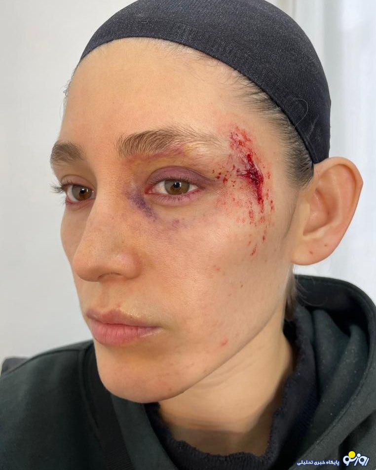 آثار ضرب و شتم روی صورت فرشته حسینی /تصاویر