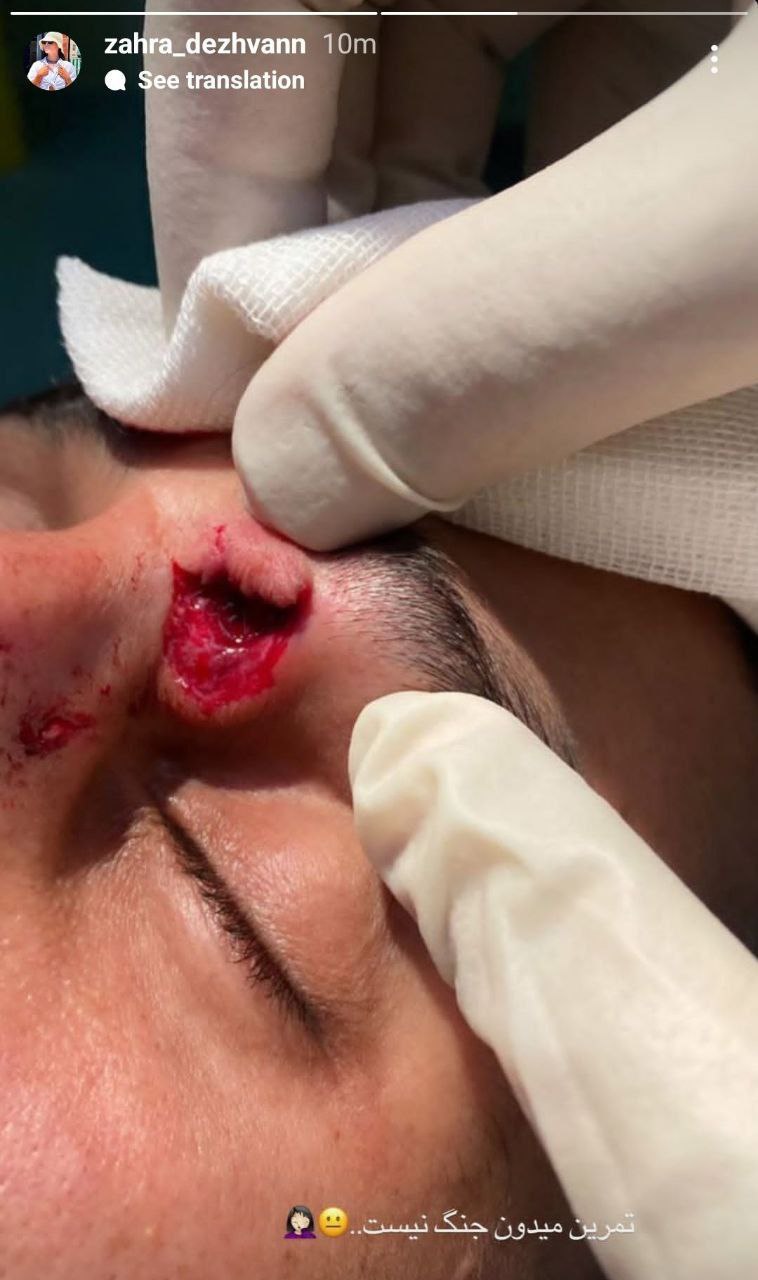 عکس از استوری همسر علی علیپور از جراحت علیپور