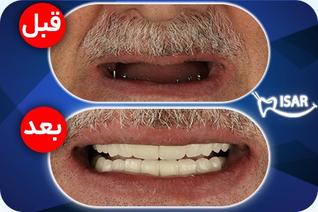 ایمپلنت و ارتودنسی و کامپوزیت دندان