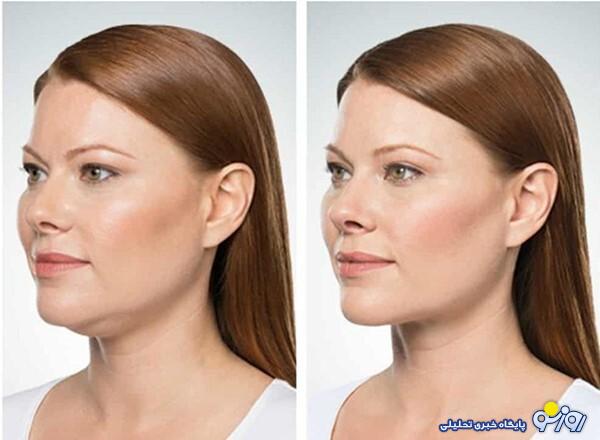 علت لاغری بیش از حد صورت چیست؟