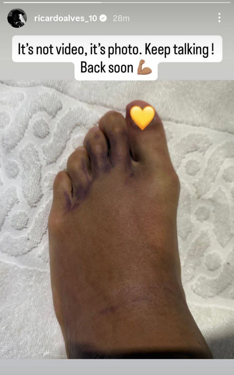 تصویری عجیب از پای مصدوم بازیکن سپاهان