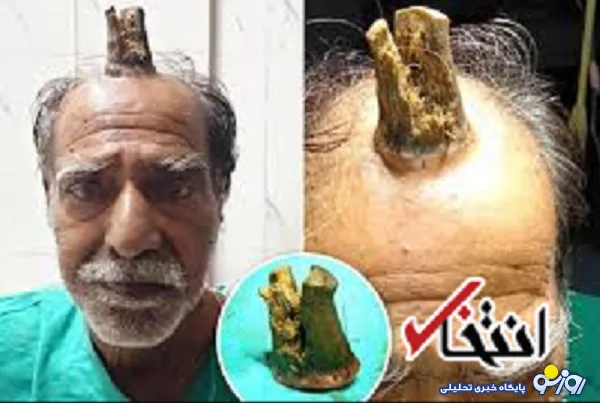 خارج کردن شاخ شیطان از سر مرد هندی ! +عکس