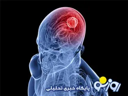 علائم تومور مغزی